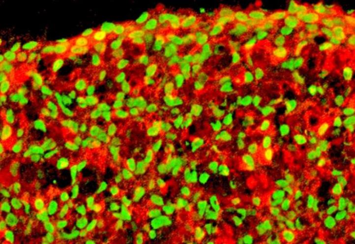 Células beta pancreáticas derivadas de células humanas iPS. En rojo: insulina. En verde: células NKX6.1