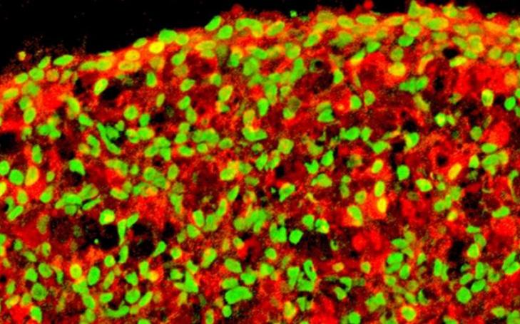Células beta pancreáticas derivadas de células humanas iPS. En rojo: insulina. En verde: células NKX6.1
